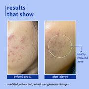 Plum Goodness 1% Salicylic Acid Clearly Gentle Gel Face Wash For Acne-Prone Skin