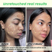 Plix 2% Salicylic Acid Serum for Active Acne & Blackheads – 30 ml