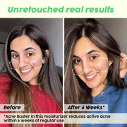 Plix Niacinamide Moisturizer For Pimples, Active Acne & Oily Skin – 50 gm