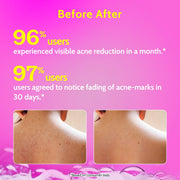 Chemist At Play 1% Salicylic Acid Body Wash for Body Acne - 236 ml