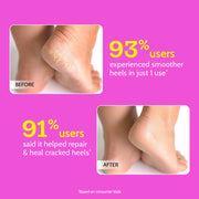 Chemist At Play 20% Urea Hydrating Foot Roll-On for Cracked Heels & Diabetic Foot - 50 gm | Pack of 2