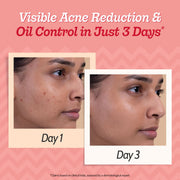 Chemist At Play 2% Salicylic Acid Face Serum With Lactic Acid For Acne Control - 30 ml